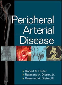 Peripheral arterial disease